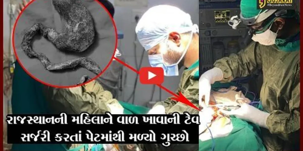 બનાસકાંઠા : મહિલા 20 વર્ષથી પોતાના જ વાળ તોડી ખાતી હતી, સર્જરી કરતાં પેટમાંથી મળ્યો ગુચ્છો