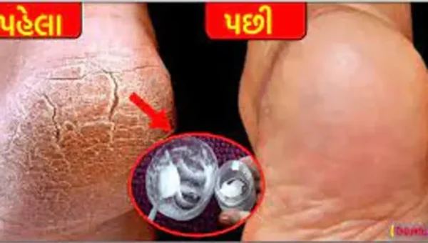 પગની ફાટેલી એડીઓ રાતોરાત થઈ જશે કોમળ, આ ઘરેલુ નુસ્ખાઓ અજમાવો મળશે 100 ટકા પરિણામ…..