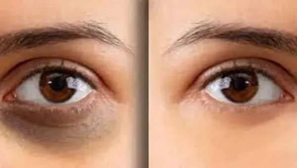 શું તમારી આંખોની નીચે કાળા કુંડાળા પડી ગયા છે? તો હવે ફિકર નોટ… આ ટિપ્સને ફોલો કરસો તો કુંડાળા ગાયબ..!